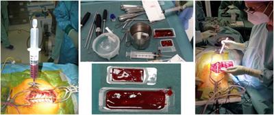 Safety and efficacy of autologous bone marrow clot as a multifunctional bioscaffold for instrumental posterior lumbar fusion: a 1-year follow-up pilot study